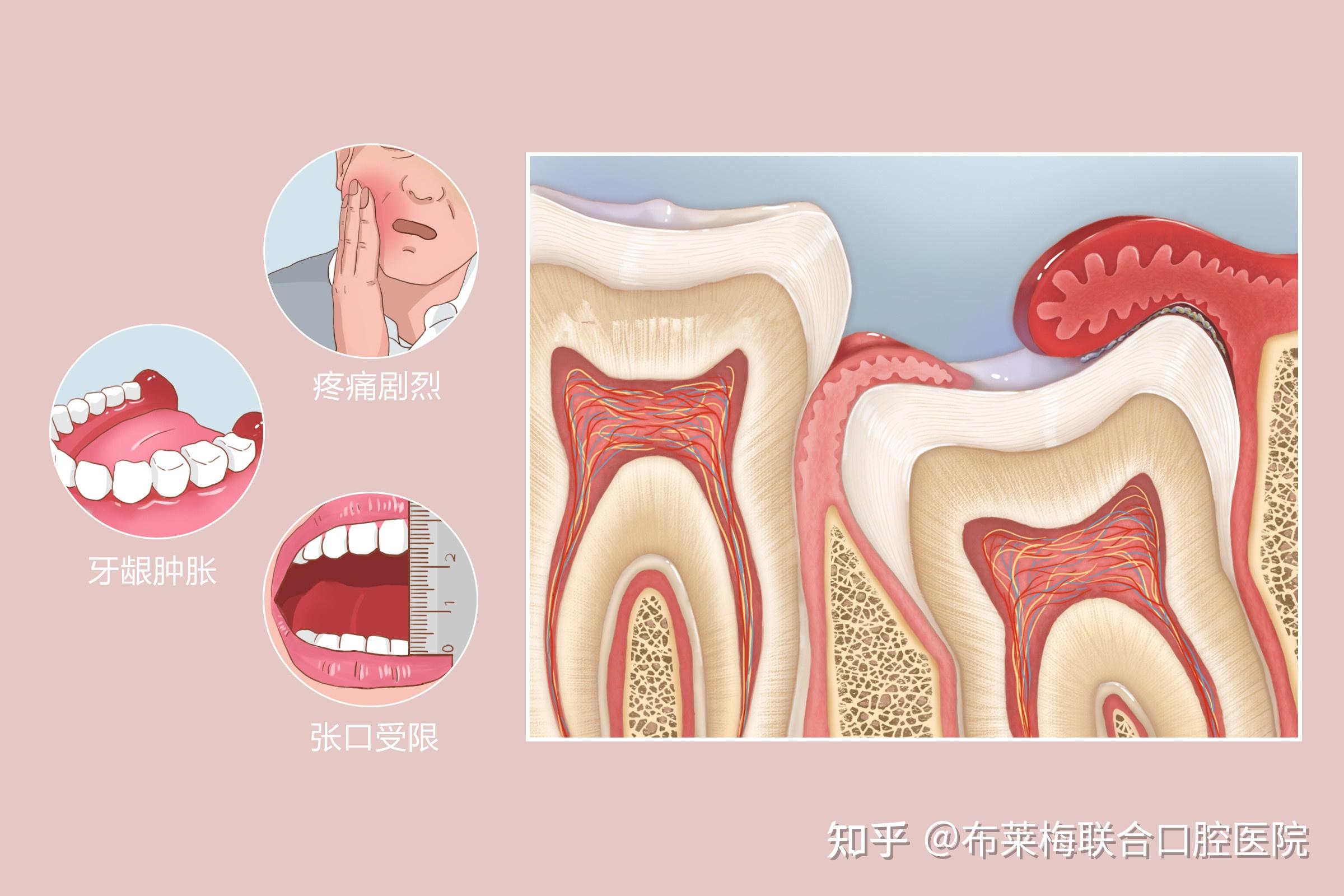 长智慧齿一定会痛吗