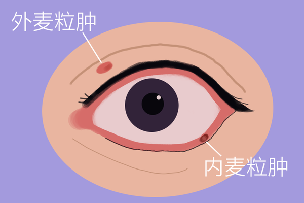 麦粒肿or霰粒肿如何分辨