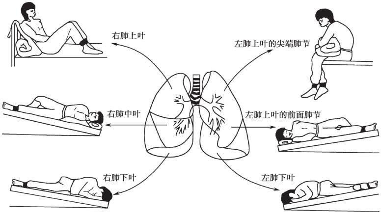 第五节 支气管扩张病人的护理 - 内科护理学(第 4 版)