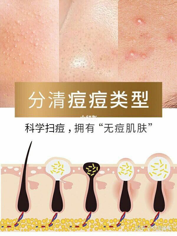 科学扫痘分清痘痘类型摆脱面子问题拥有无痘肌肤