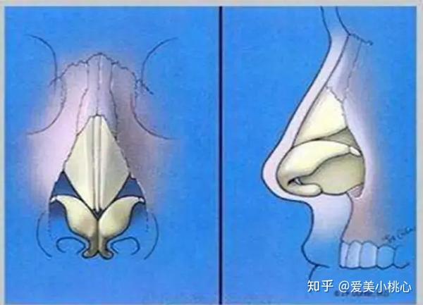 对于鼻头支撑方面很重要的两瓣软骨——鼻翼软骨.