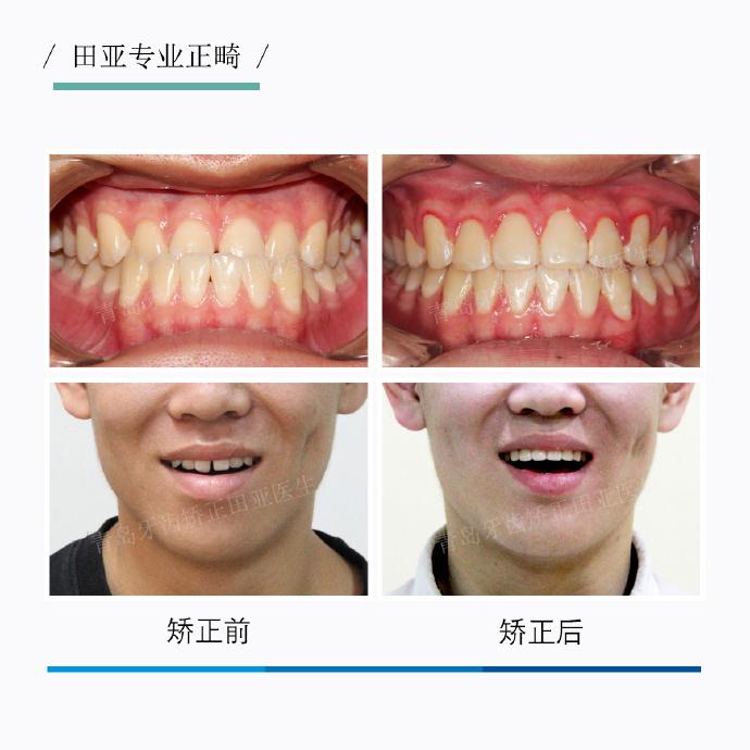 青岛牙齿矫正骨性地包天正畸案例2