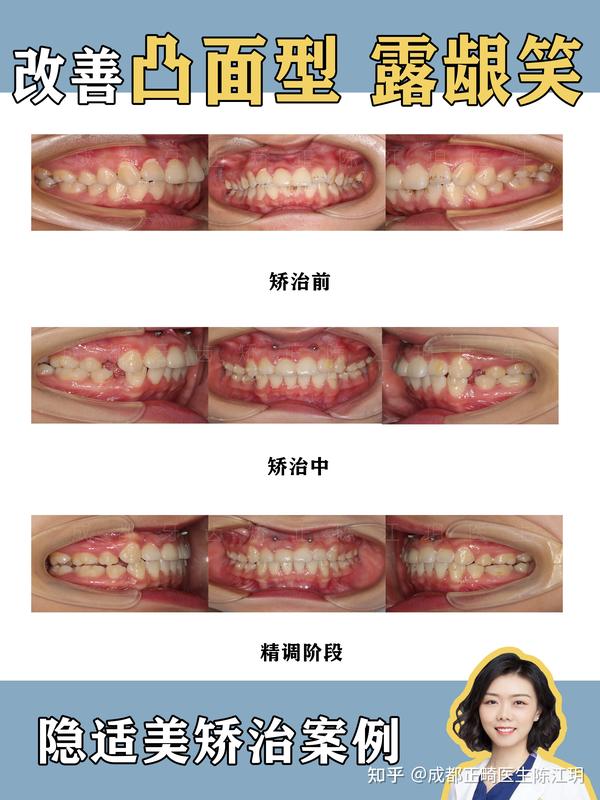 成都牙齿矫正丨改善凸面型 露龈笑