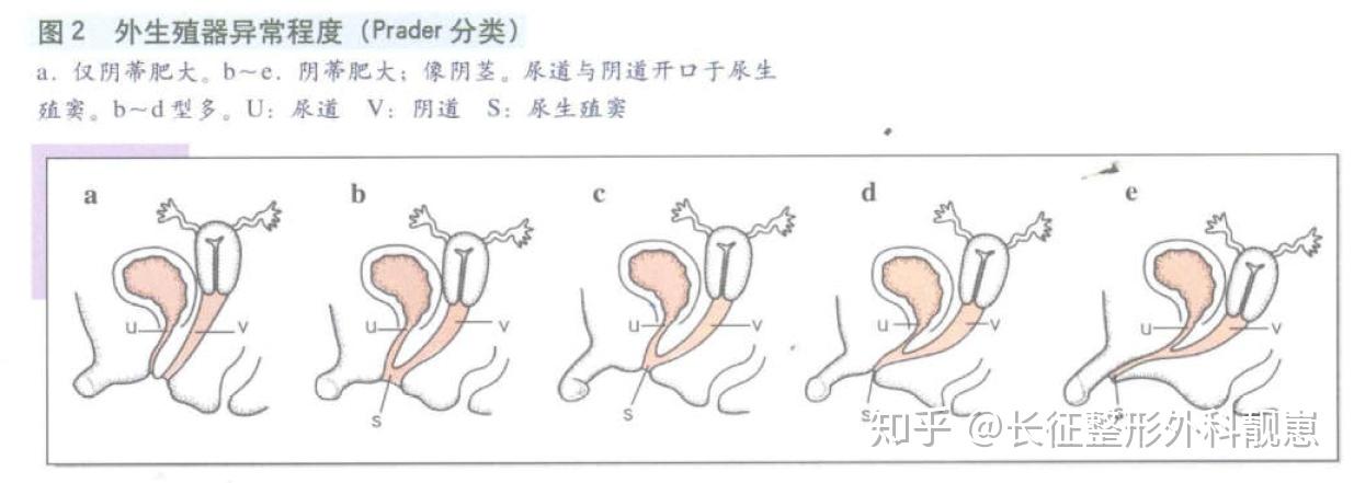 性别畸形科普六之女性假两性畸形