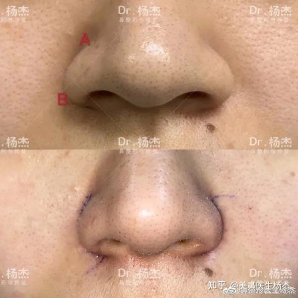 什么情况下缩鼻翼效果最好