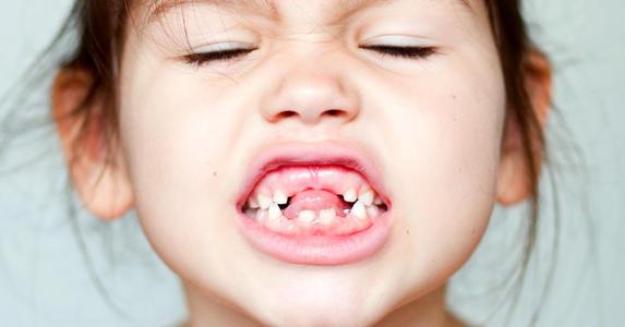 仙游牙齿矫正:孩子出现畸形牙都有哪些原因呢?