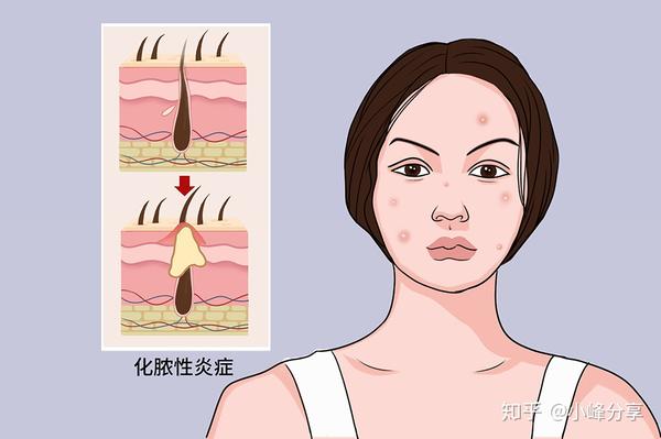二,引起毛囊炎的原因