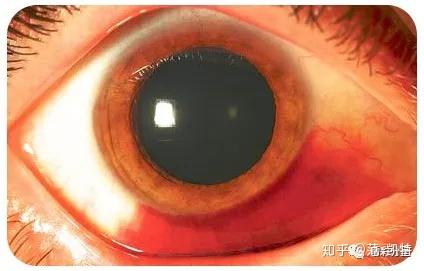 结膜下出血虽然不如眼底出血那么严重,但是眼睛红了一大片,还是影响