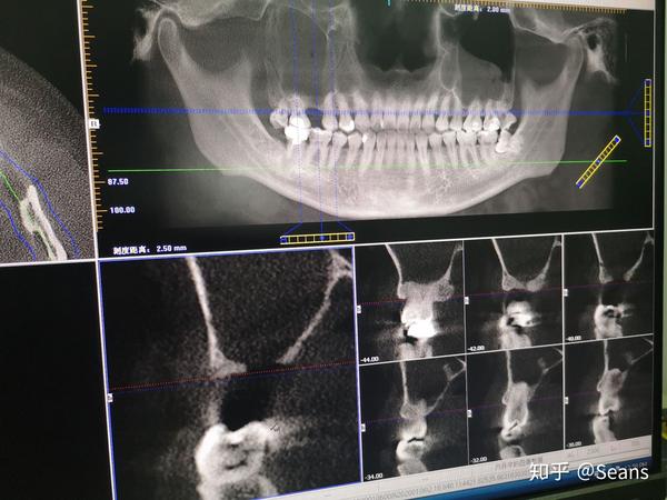 拔牙引起上颌窦穿孔是什么体验?