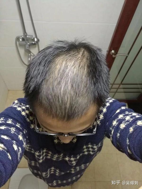 米诺地尔,看抗过敏米诺地尔防脱生发,脂溢性脱发 米诺地尔,保法止权威