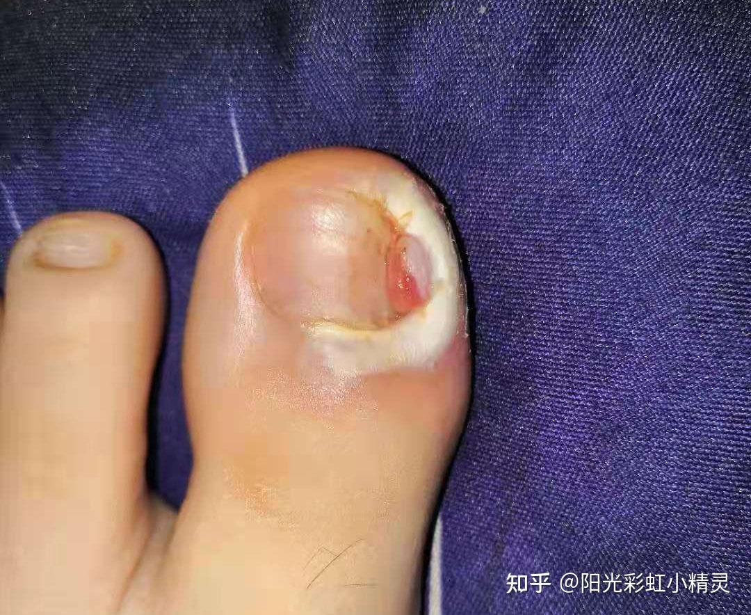 甲沟炎剪完了指甲不扎肉但是息肉肿大覆盖指甲等指甲长长需要修剪的