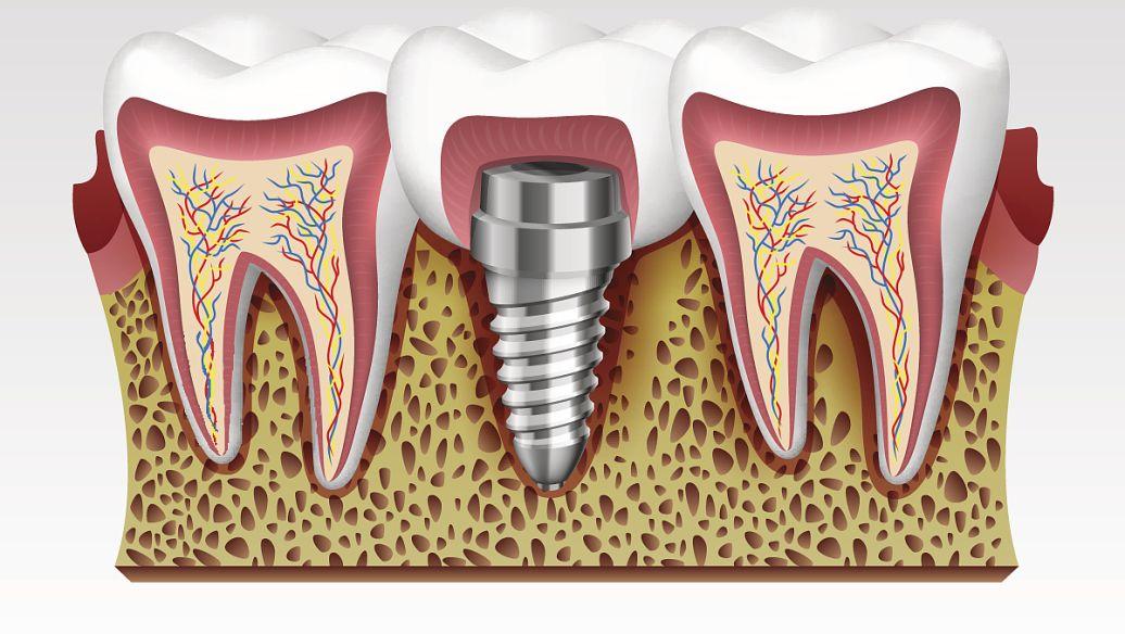 种植牙是什么效果好吗种植牙多少钱医院医生怎么选成都种植牙攻略必看