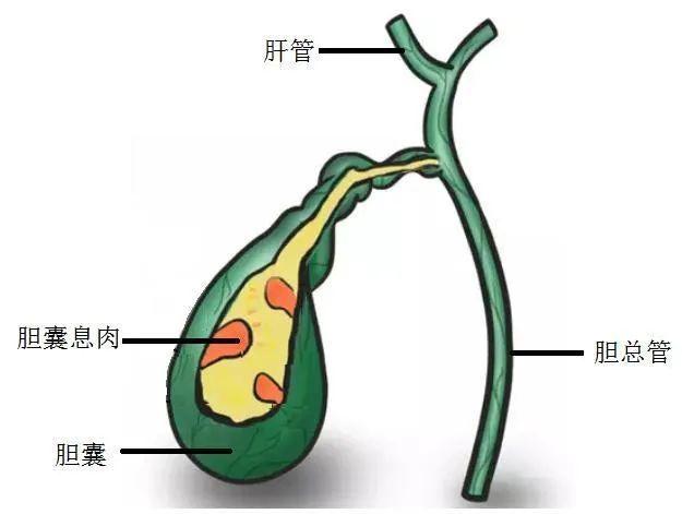 做过胆囊切除,手把手教你买保险|附投保真实案例