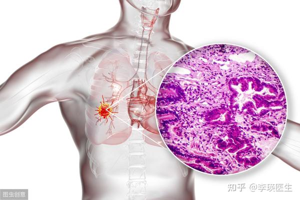 度伐利尤在美获批广泛期小细胞肺癌一线治疗史上最长生存期方案