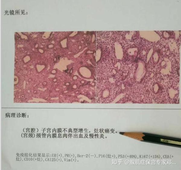 腺肌症绝经后不要高枕无忧,当心要命的猛兽突然侵袭!
