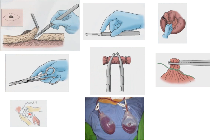 mooc《外科手术学》——第六讲 外科基本操作(一)切开,分离,结扎,止血