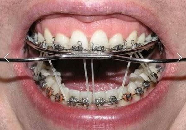 戴牙套到底有多疼?