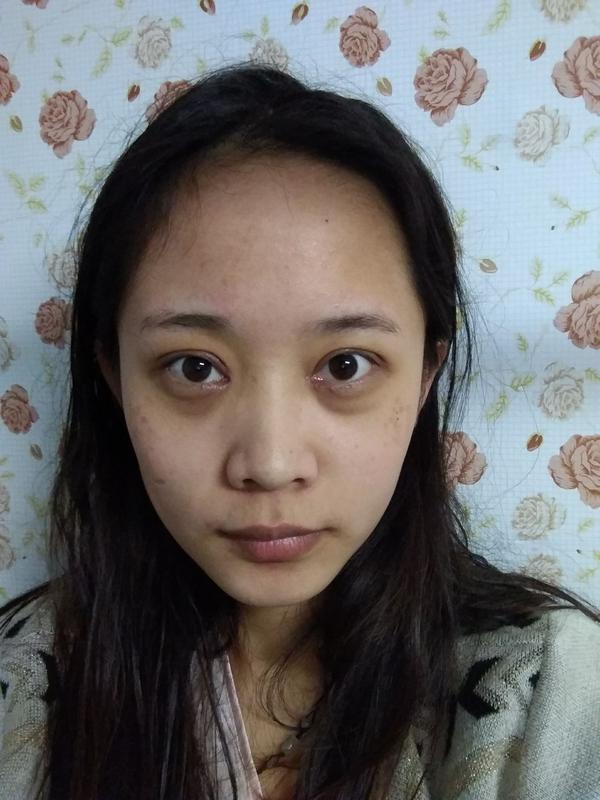 双眼皮 全切6mm&开眼角
