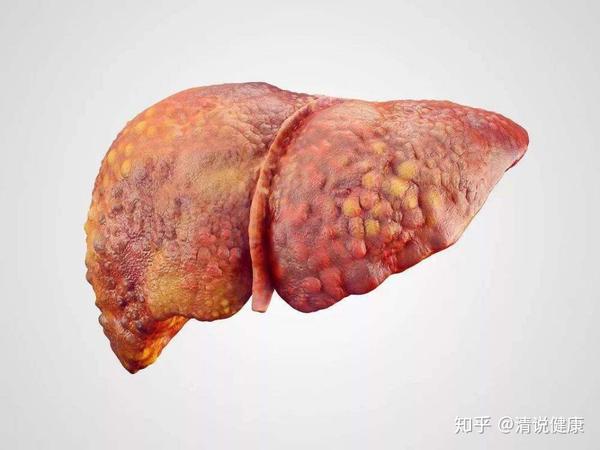 大便2异常或已被癌细胞盯上一个不占恭喜肝很健康