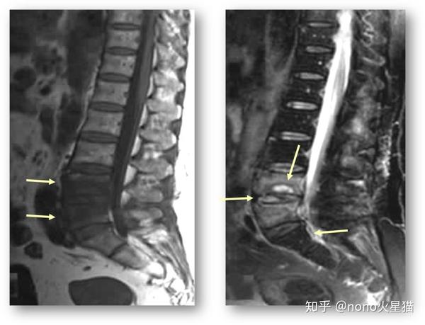 腰4,5 椎体相邻终板呈许莫结节样骨质破坏,椎间隙轻度变窄,椎间盘炎性