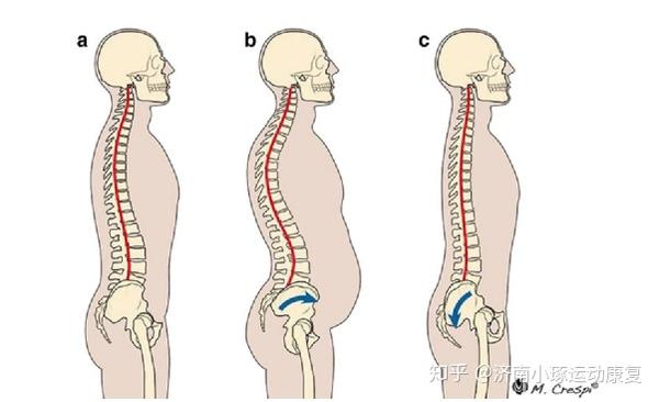 体态不好,骨盆前后倾如何改善「小琢运动康复」