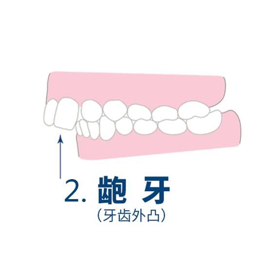地包天即下排牙齿包住上排牙齿,下颌前伸,严重影响面容美观,导致咀嚼