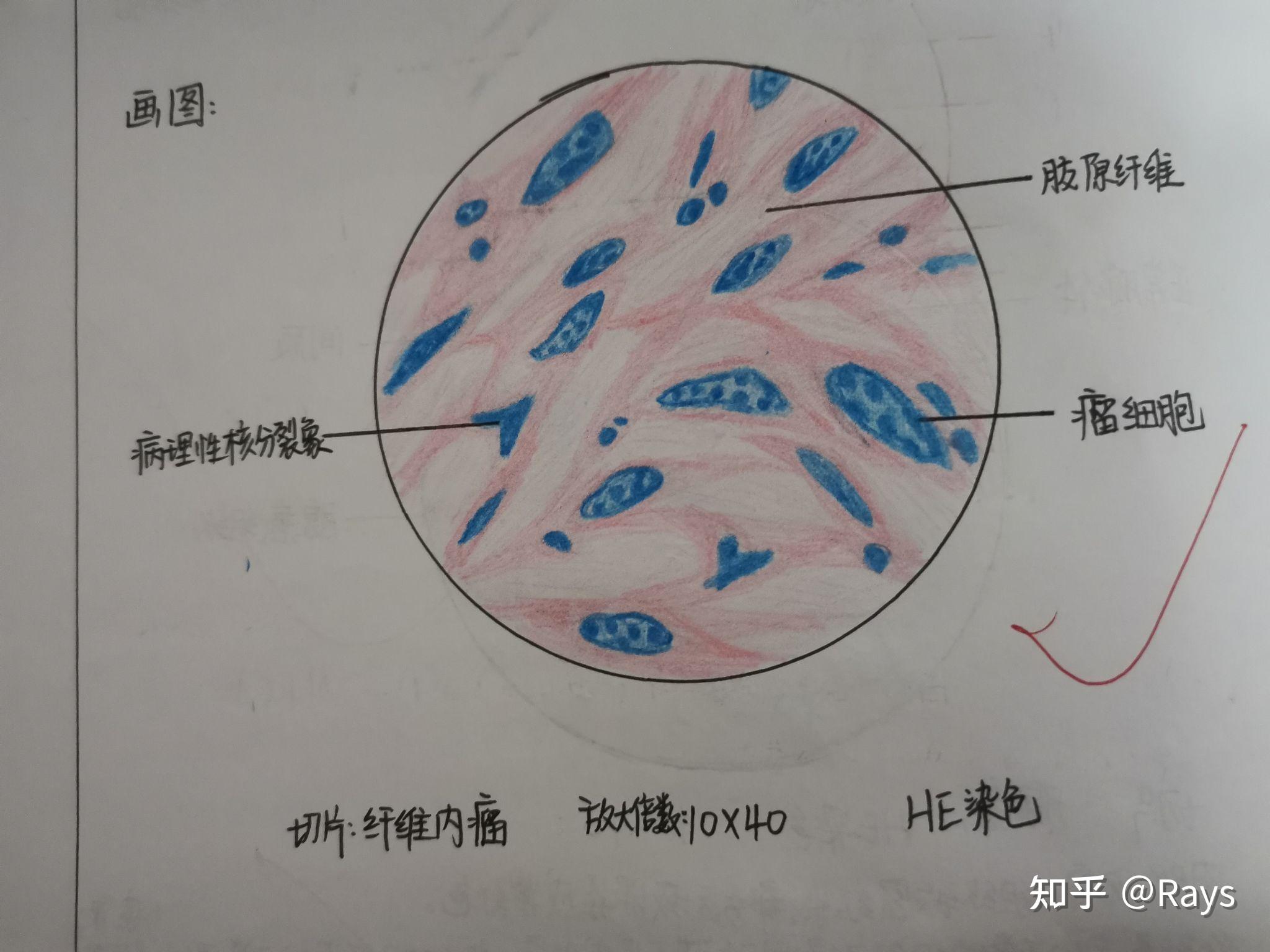 病理红蓝铅笔绘图