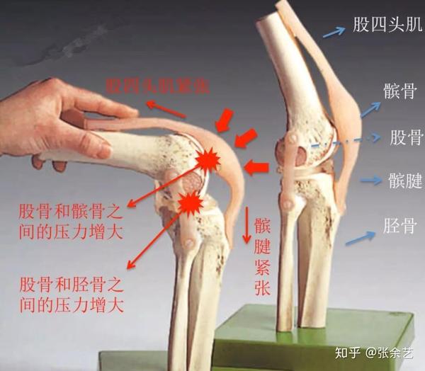 1,从膝关节解剖结构说起 膝关节主要由3个相互分离的骨头组成,分别是