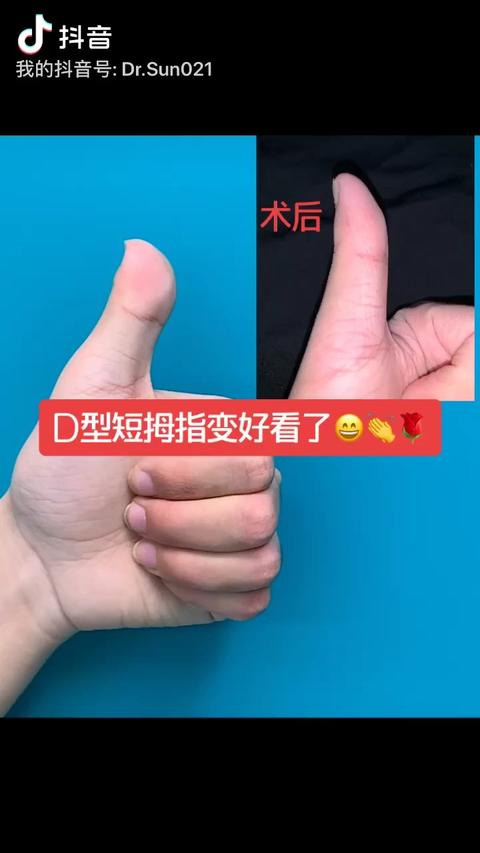 d型短指症 知乎