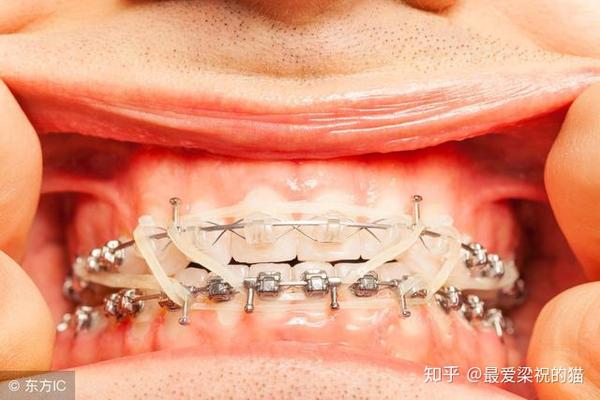 牙齿矫正会不会有后遗症?牙齿矫正会带来哪些副作用?