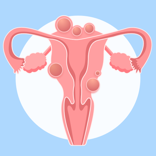体检查出子宫肌瘤怎么办?还可以怀孕吗?