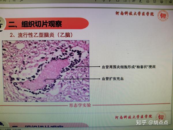 流行性乙型脑炎(乙脑),粟粒性肺结核病理诊断及病理切片