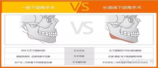 颌面整形案例 | 方脸,国字脸有救了,治病良方原来是这个!