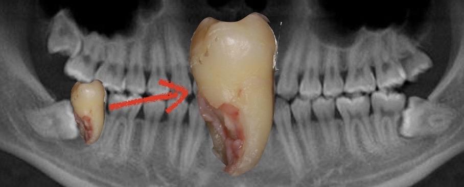 计划口腔医学牙齿牙科牙医拔牙智齿相关推荐 4:40牙医视角,补牙全过程