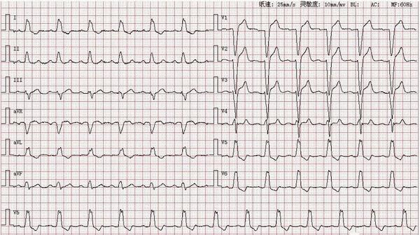 心电图图库丨完全性左束支阻滞系列