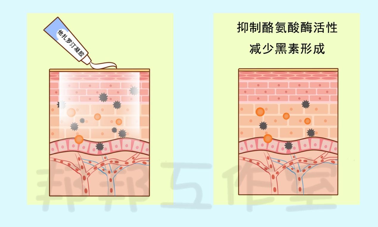 雀斑和黄褐斑是怎么引起的_色斑的形成原因有哪些(河南祛斑)