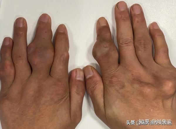 多个手指及手背出现痛风石,累及关节超过4个属重度痛风石性关节炎