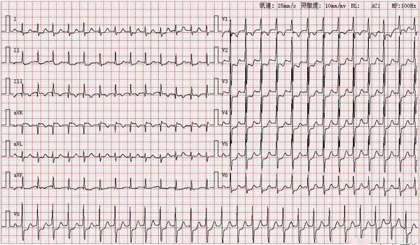 心电图图库丨室上性心动过速系列