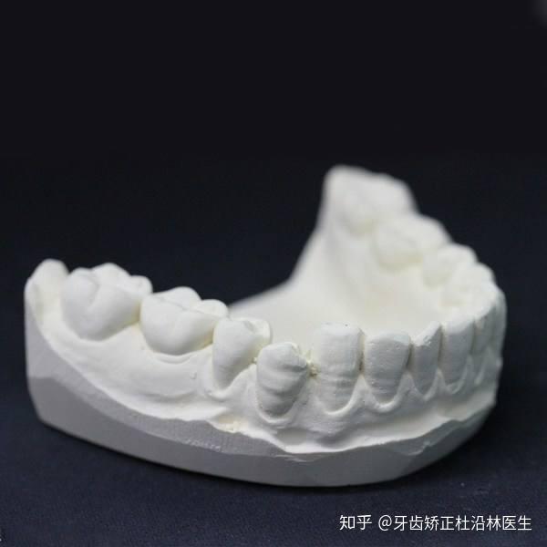 取模:传统矫正取石膏模,全隐形矫正需取硅橡胶模,有助于诊断和方案