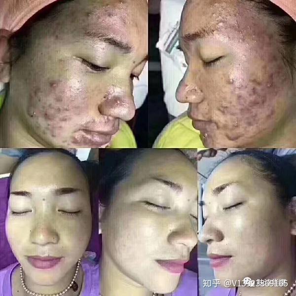 我们祛斑的原理:是采用生物酶技术提取并根除病变黑色素细包到表皮层