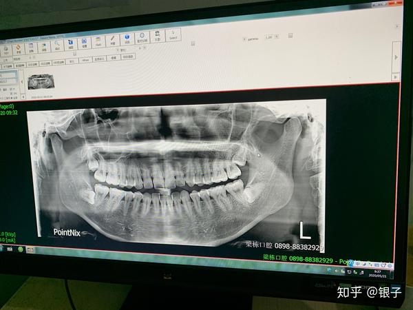 今天跟大家分享一下我拔阻生齿的过程,希望大家也多关注自己的牙齿