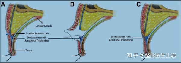我和我的解剖学(1)解剖学与重睑手术的关系