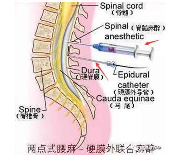 剖腹产的麻醉针长得吓人,会插坏腰和脑子?