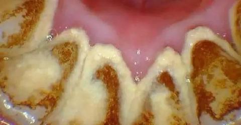 怎么去除牙结石 知乎