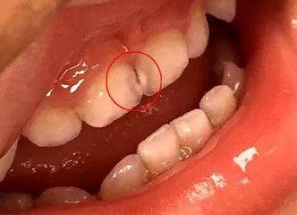 孩子的牙齿可不可以做根管治疗?
