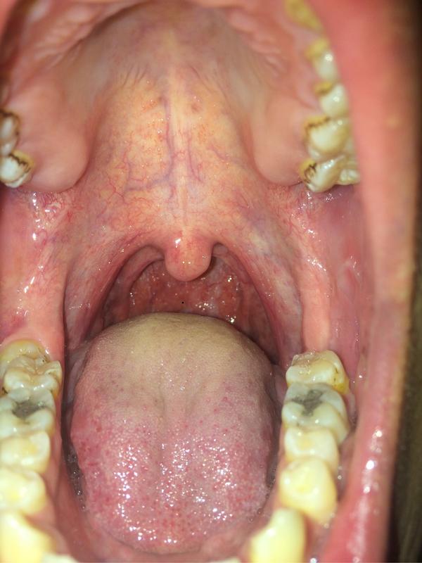 喉咙里面有白泡快一个星期了 没啥疼痛感 有异物感 睡醒之后喉咙好不