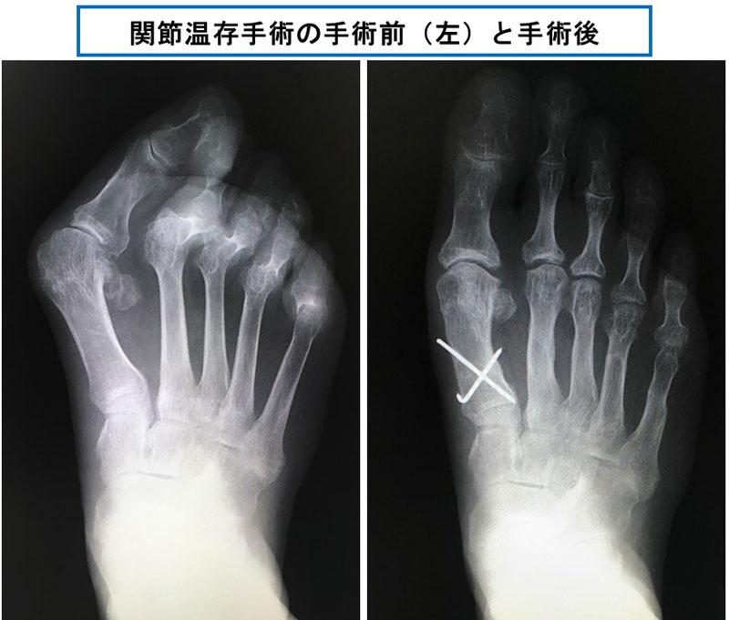 类风湿脚变形的最近治疗方法