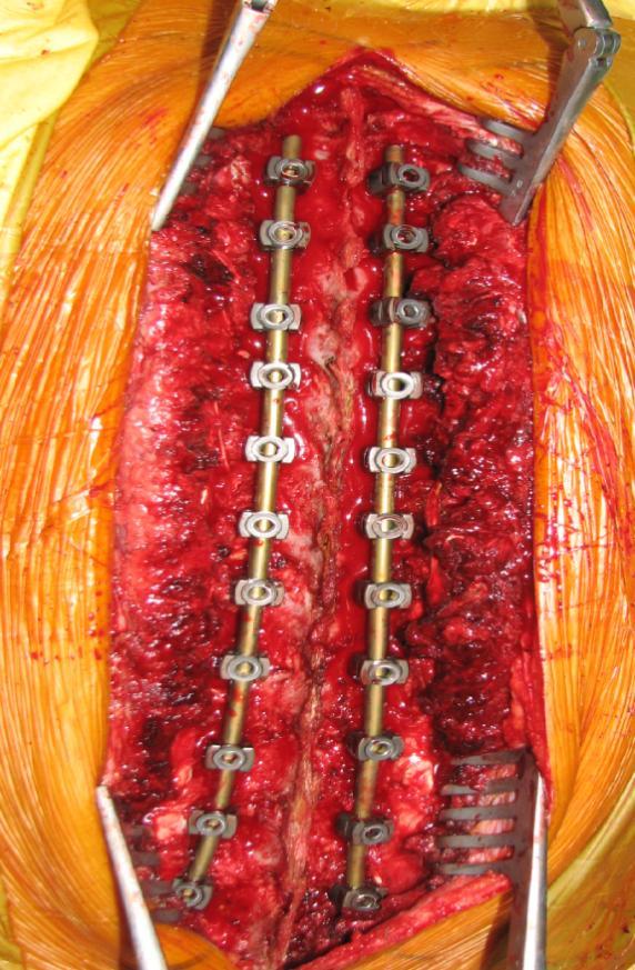 传统康复 结构性脊柱侧凸:手术治疗 功能性脊柱侧凸:30度以下的支具