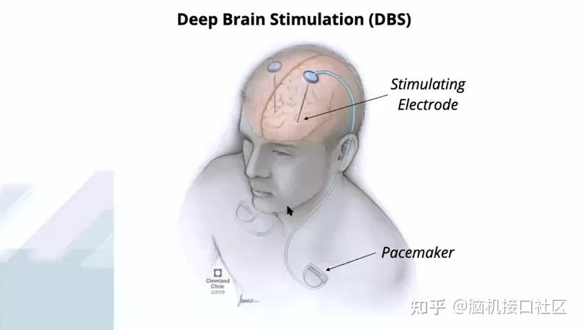 cmu研究人员提出一种新的深部脑刺激方法可延长帕金森病治疗效果