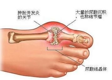 痛风患者体内的尿酸结晶沉积在关节等软组织部位形成的一种坚硬如石的